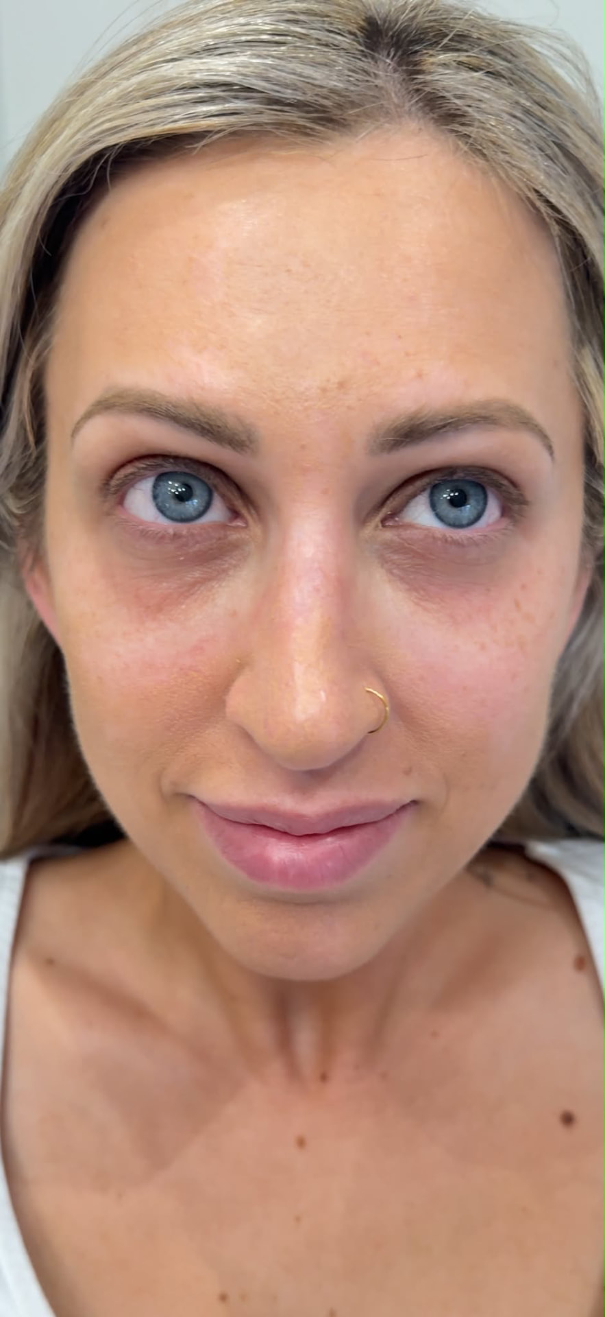 After treatment